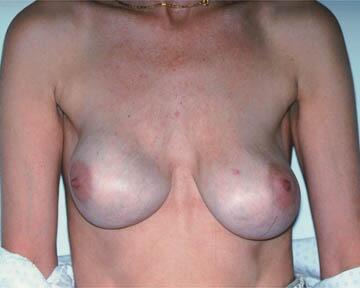 Breast Implant Correction Before & After Image