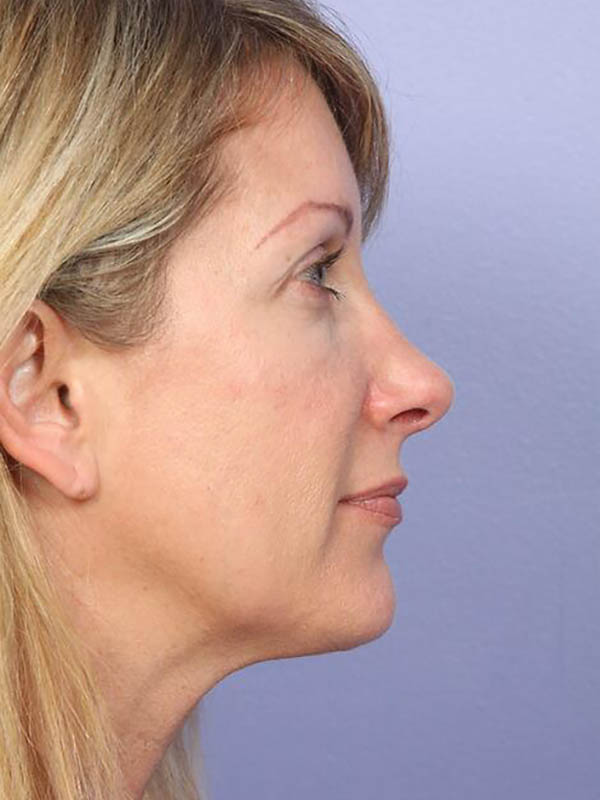 Chin & Cheek Shaping Before & After Image