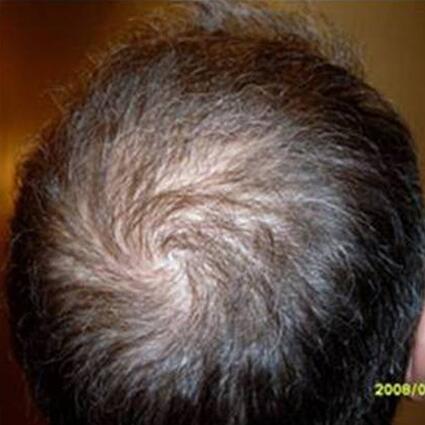 Hair Restoration by NeoGraft® Before & After Image