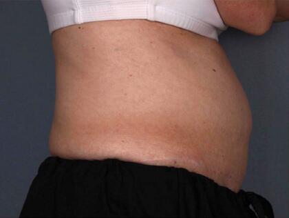 Liposonix® Before & After Image