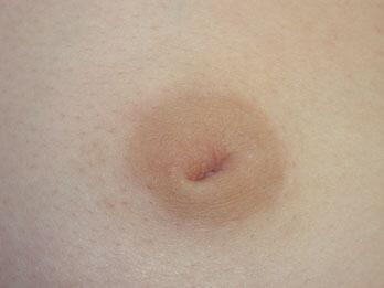Nipple - Inversion Correction Before & After Image