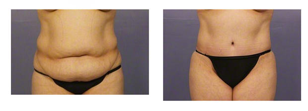 Tummy Tuck Before And After Photos