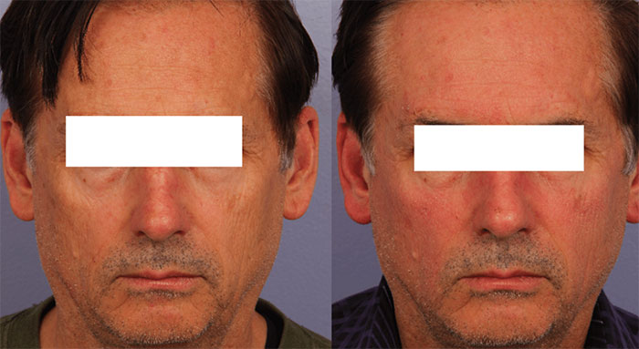 Halo Laser Treatment Before and After Photo