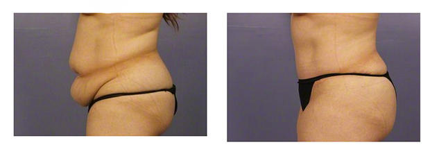 4 Types of Tummy Tuck Procedures Offered By Ohio Plastic Surgery  Specialists - Ohio Plastic Surgery Specialists