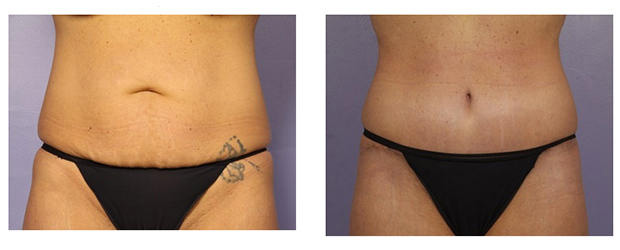 Tummy Tuck Before And After Photos