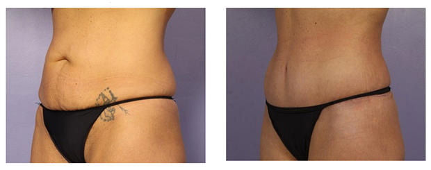 Tummy Tuck Before And After Photos