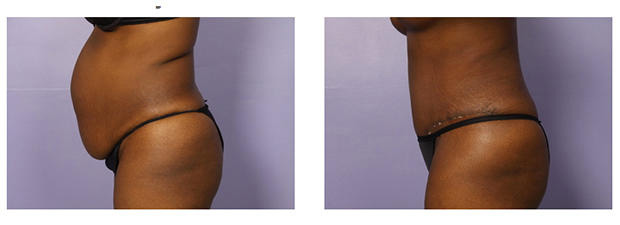 Tummy Tuck Before And After Photos