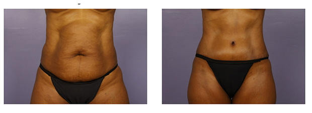 Tummy Tuck Before And After Photos