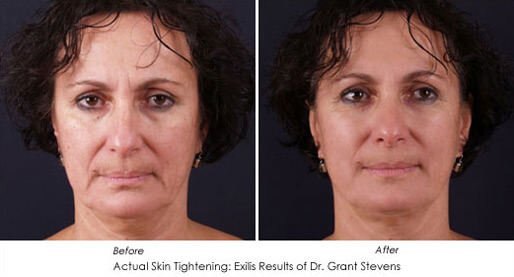before and after exilis