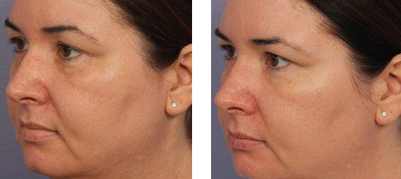 HALO Laser treatment before & after