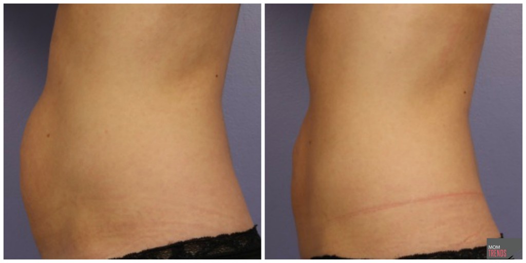 CoolSculpting results