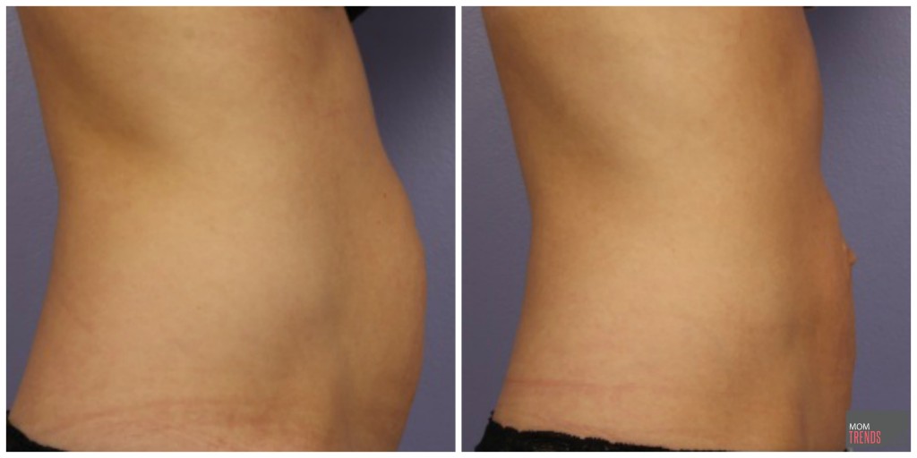 Cool Sculpting results