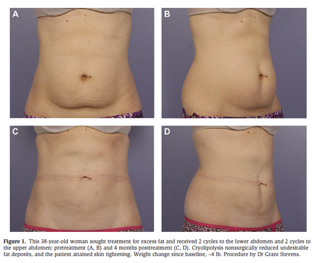 Does Coolsculpting Tighten Skin?