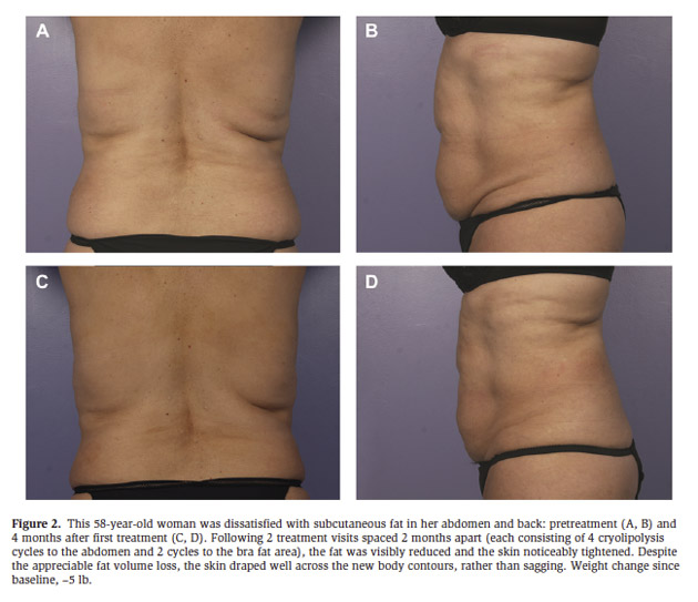 cryolipolysis_Figure2