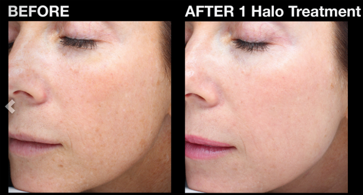 HALO Laser treatment before & after