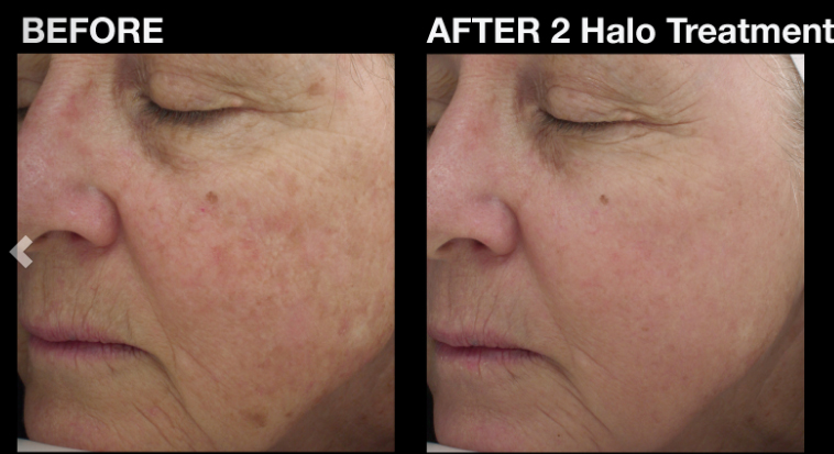 HALO Laser treatment before & after