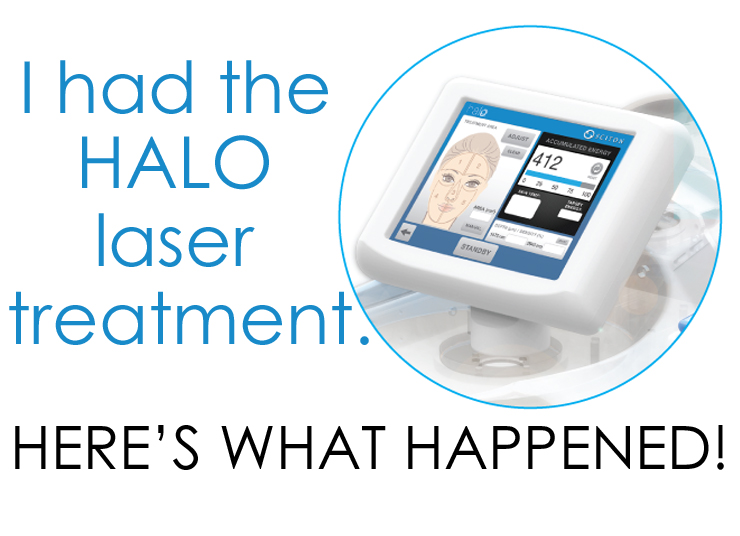 I Had the HALO Laser Treatment, Here’s What Happened