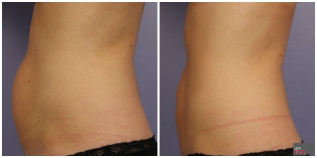 CoolSculpting results