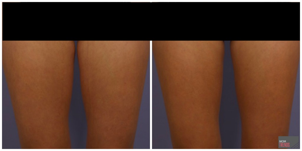 coolsculpting results