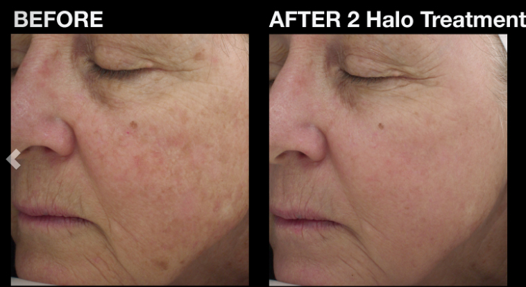 HALO Laser treatment before & after