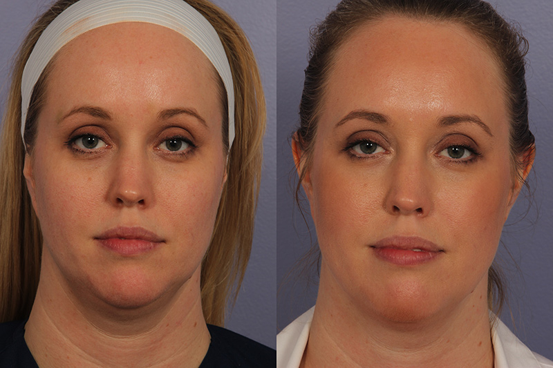 Los Angeles kybella patient before and after