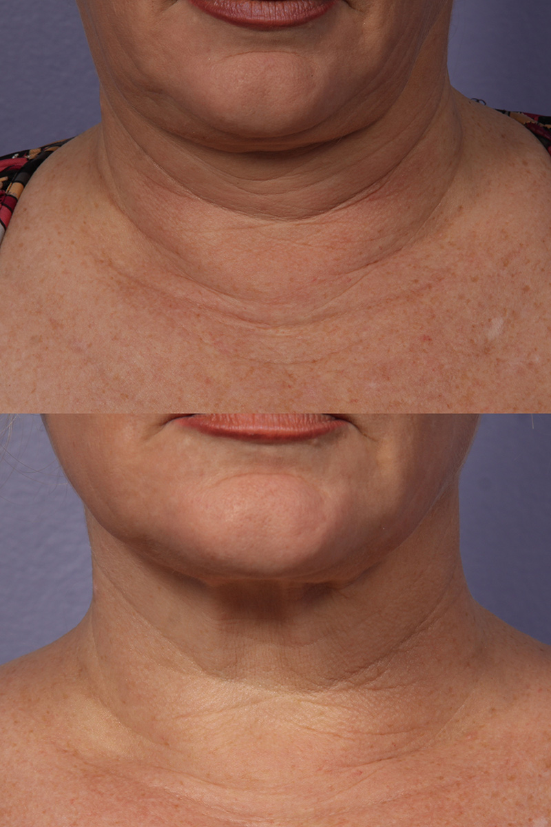 Los Angeles Ultherapy Before and After Photo