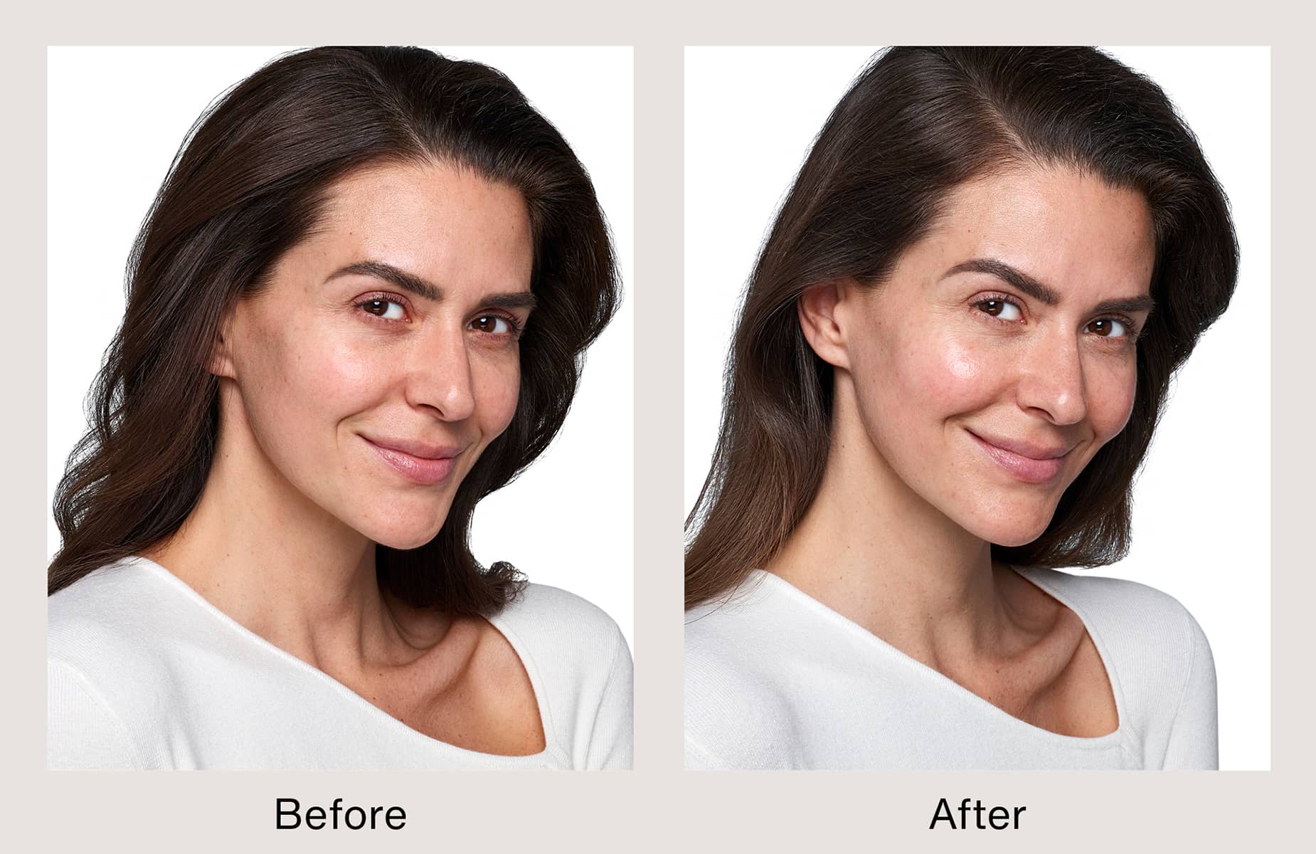 SKINVIVE Before and After real patient | Marina Plastic Surgery