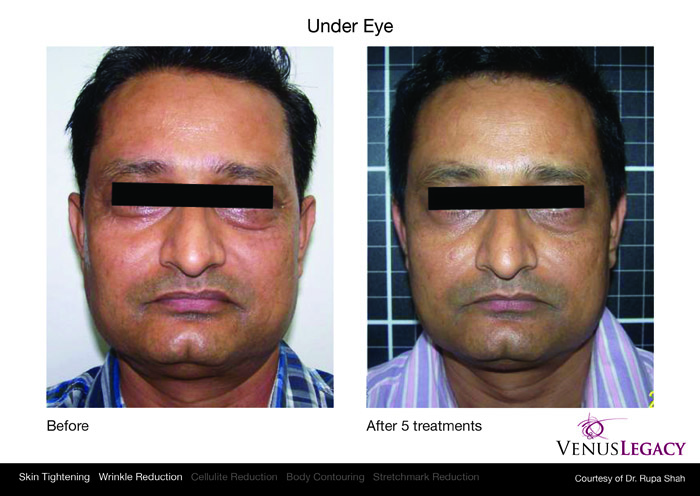 Los Angeles venus legacy patient before and after