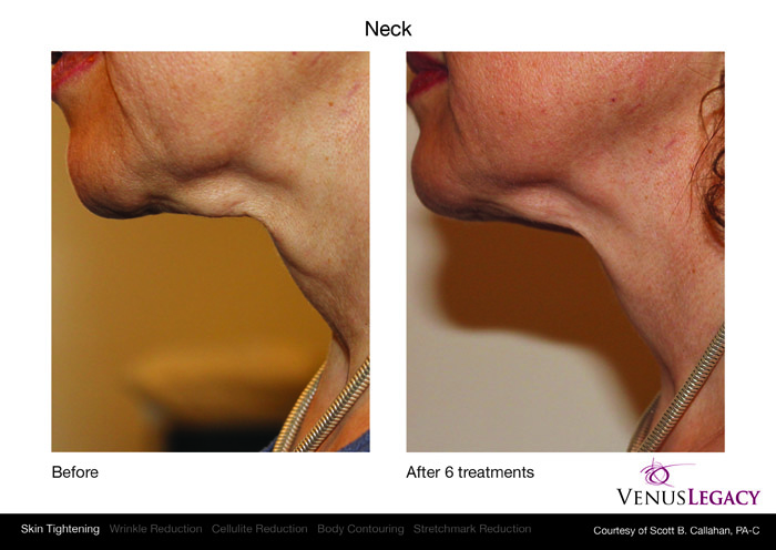 Los Angeles venus legacy patient before and after