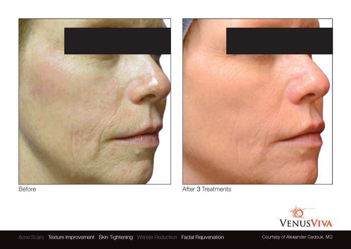 Los Angeles venus viva patient before and after