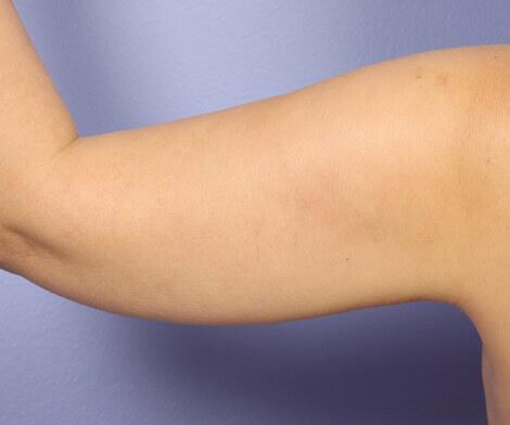 Arm Lift Before & After Image