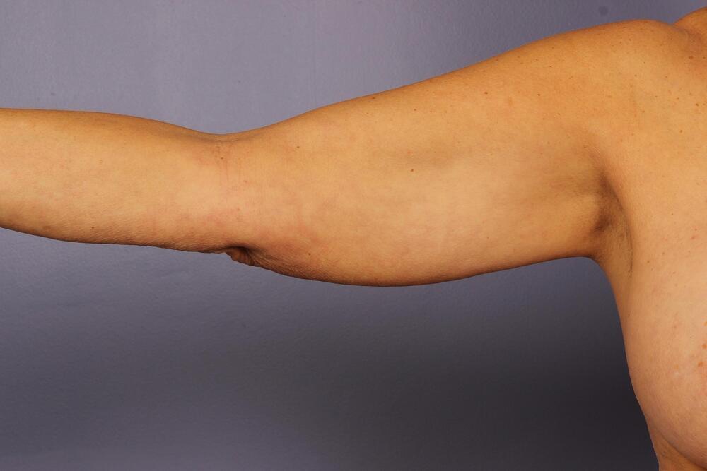 Arm Lift Before & After Image