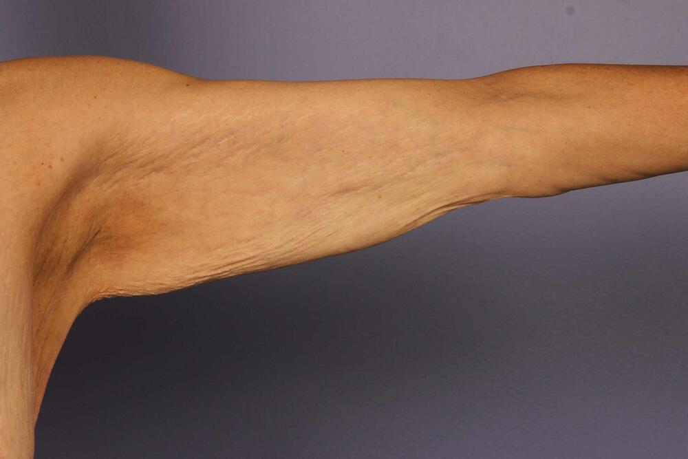 Arm Lift Before & After Image