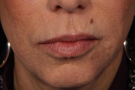 BOTOX® Cosmetic Before & After Image