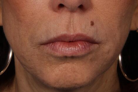 BOTOX® Cosmetic Before & After Image