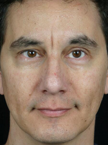 BOTOX® Cosmetic Before & After Image