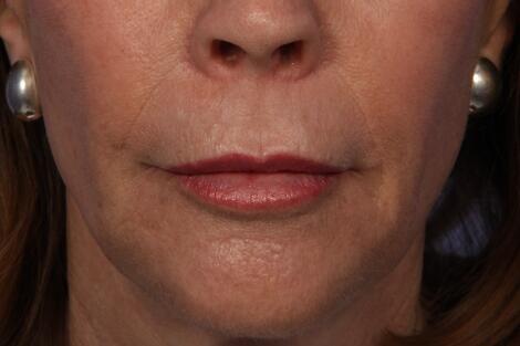 BOTOX® Cosmetic Before & After Image