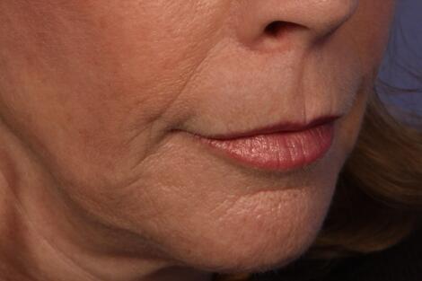 BOTOX® Cosmetic Before & After Image