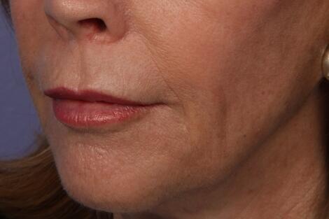 BOTOX® Cosmetic Before & After Image