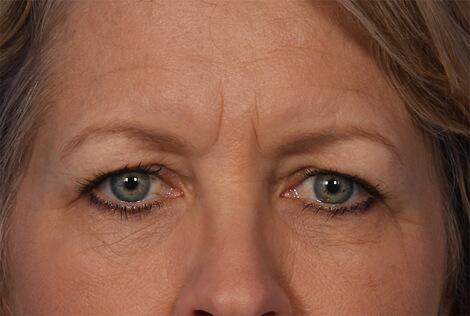 BOTOX® Cosmetic Before & After Image