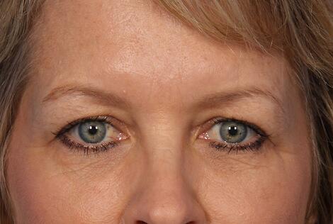 BOTOX® Cosmetic Before & After Image