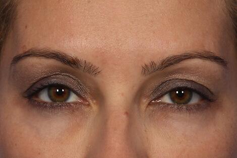 BOTOX® Cosmetic Before & After Image