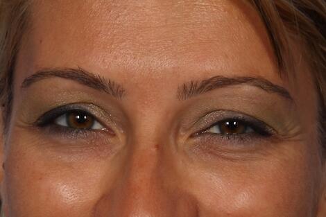 BOTOX® Cosmetic Before & After Image