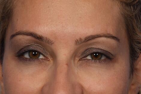 BOTOX® Cosmetic Before & After Image