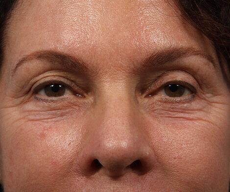 BOTOX® Cosmetic Before & After Image