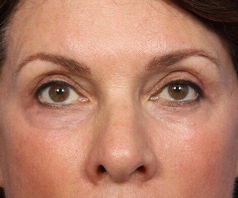 BOTOX® Cosmetic Before & After Image