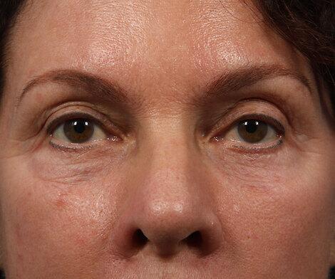 BOTOX® Cosmetic Before & After Image