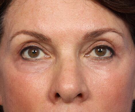 BOTOX® Cosmetic Before & After Image