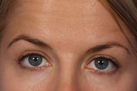 BOTOX® Cosmetic Before & After Image