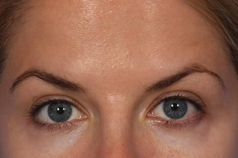 BOTOX® Cosmetic Before & After Image